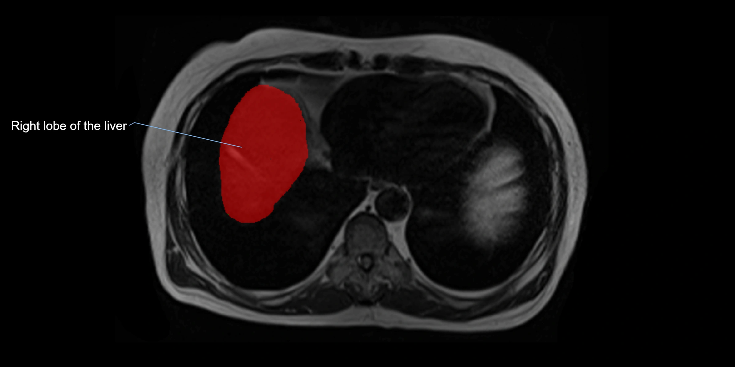 MRI liver lobe axial cross sectional 3T radiology  image-img-00001-00003.webp